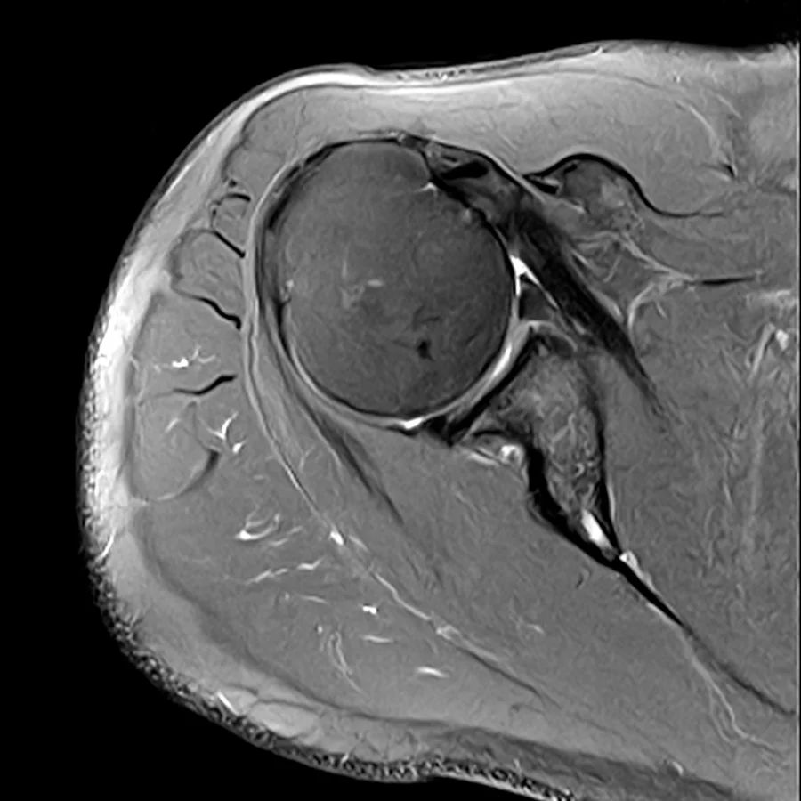Axial proton density fat-saturated shoulder MRI on a Canon Vantage Orion 1.5T, SwiftMR scan