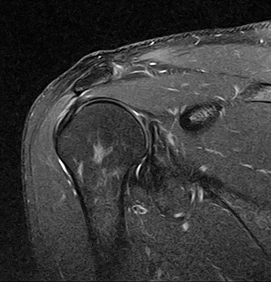 Coronal T2 fat-saturated shoulder MRI on a Canon Vantage Orion 1.5T, conventional scan