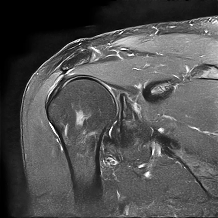 Coronal T2 fat-saturated shoulder MRI on a Canon Vantage Orion 1.5T, SwiftMR scan