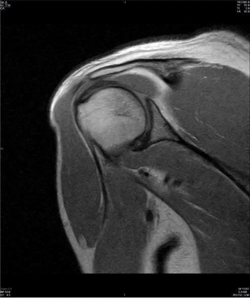 Coronal proton density shoulder MRI on a Hitachi AIRIS ELITE 0.3T, conventional scan