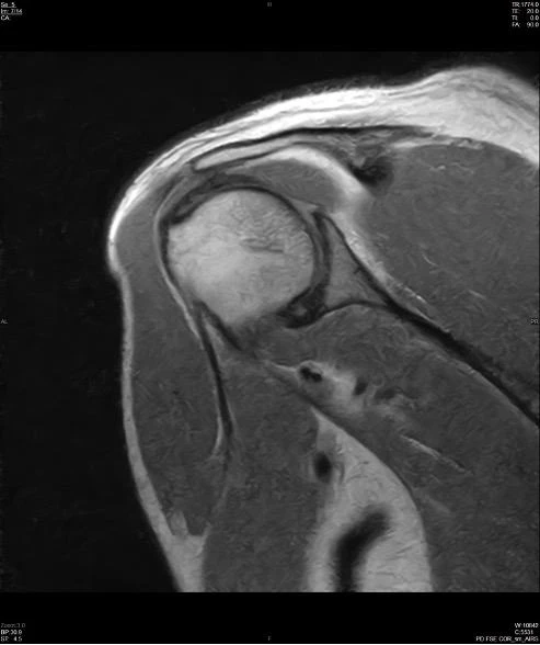 Coronal proton density shoulder MRI on a Hitachi AIRIS ELITE 0.3T, SwiftMR scan