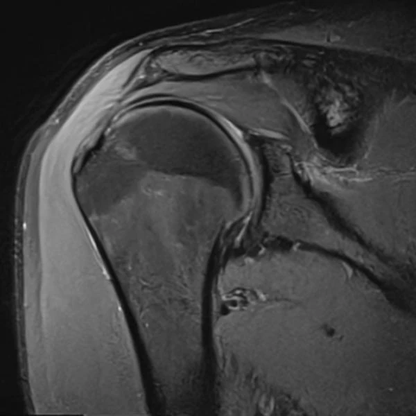 Coronal shoulder MRI, SwiftMR scan