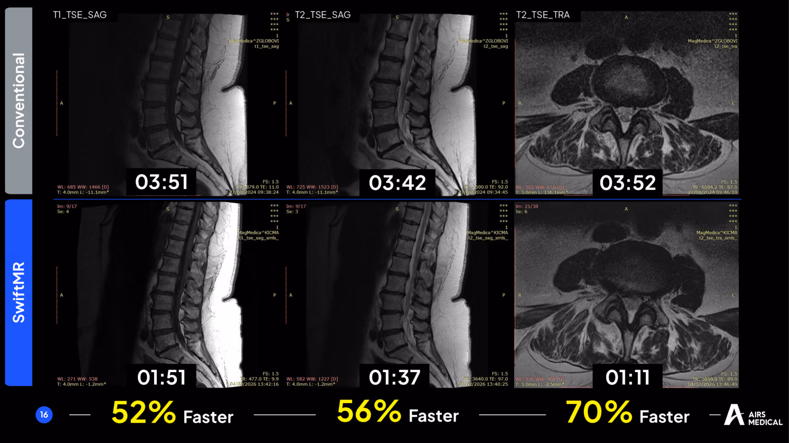 Conventional and SwiftMR lumbar spine T1 and T2 MRI sequences