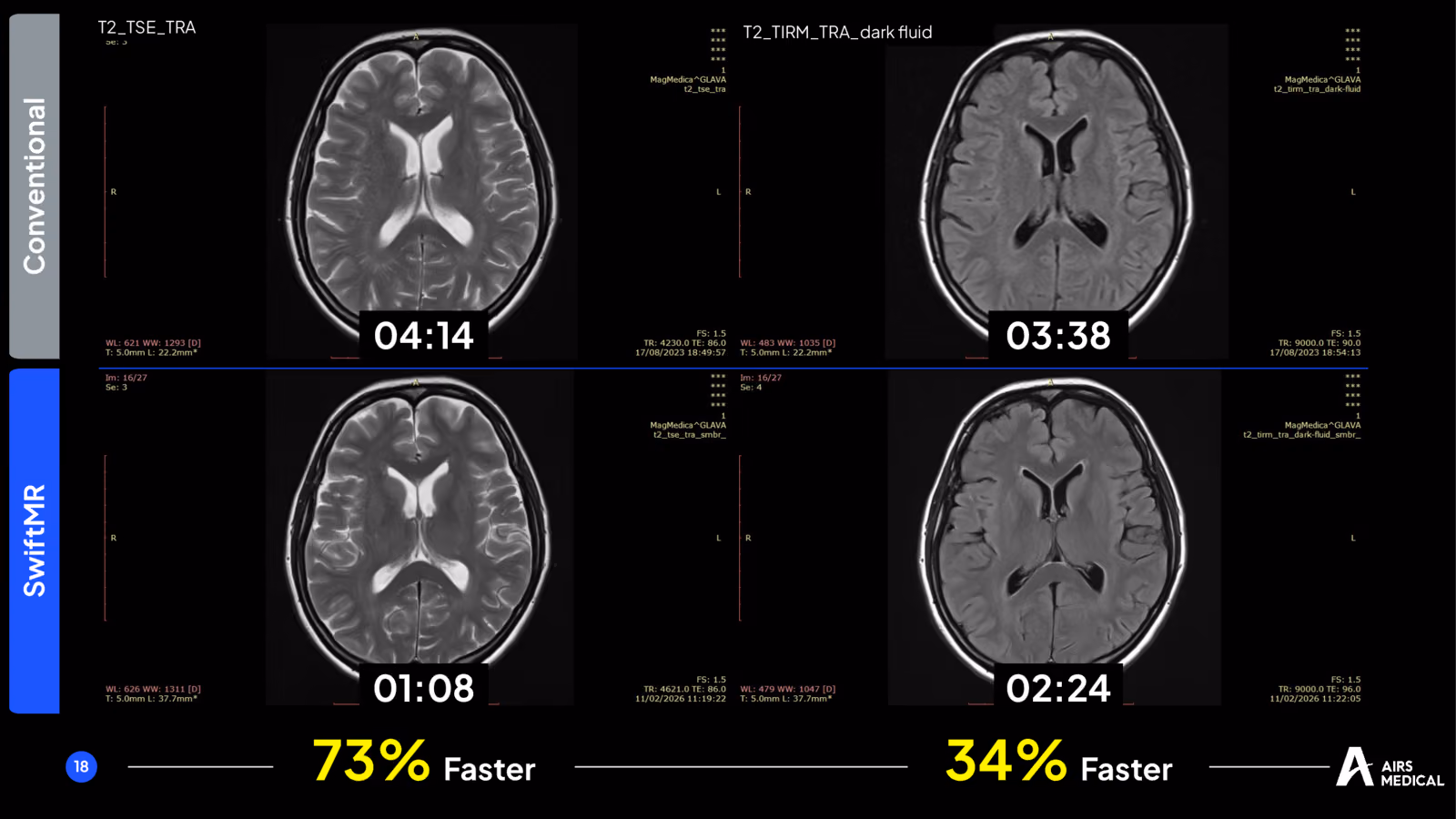 Conventional and SwiftMR brain T2 and FLAIR images