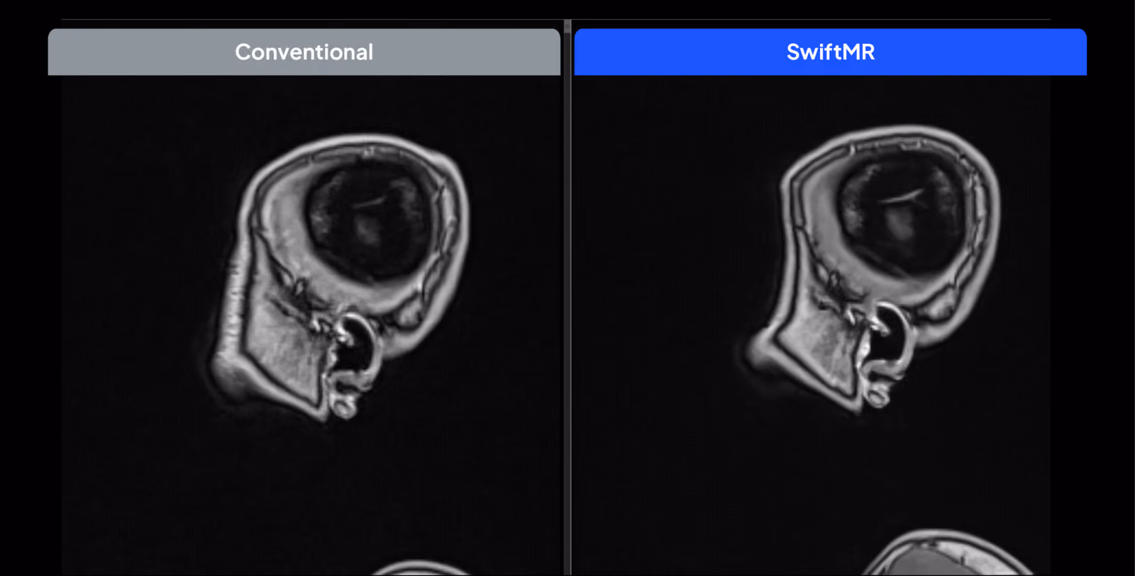 Conventional and SwiftMR 3D MR angiography reconstructions