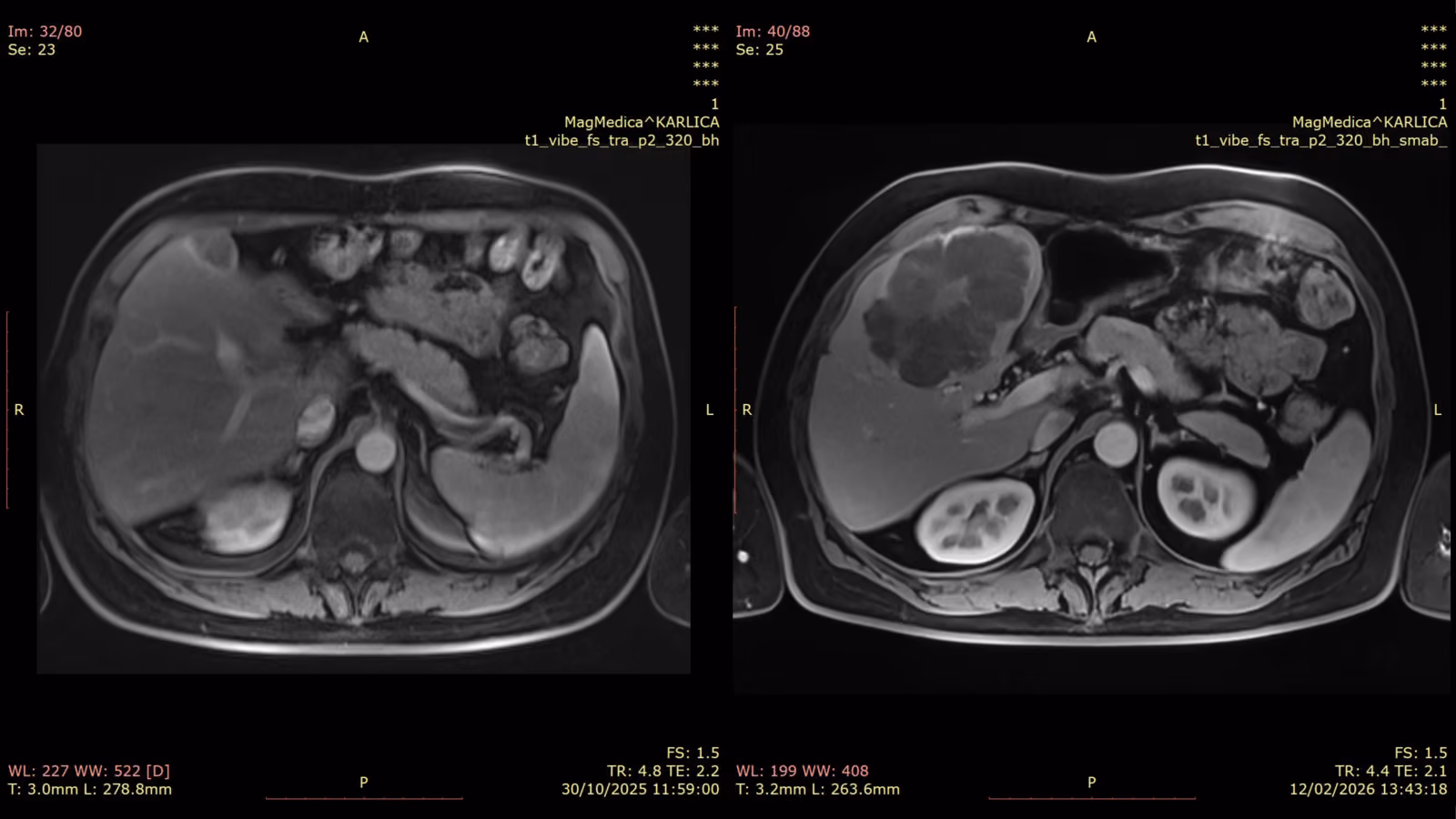 Abdominal oncologic follow-up before and after SwiftMR adoption
