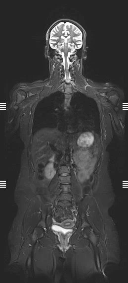 Whole-body coronal STIR MRI, conventional scan
