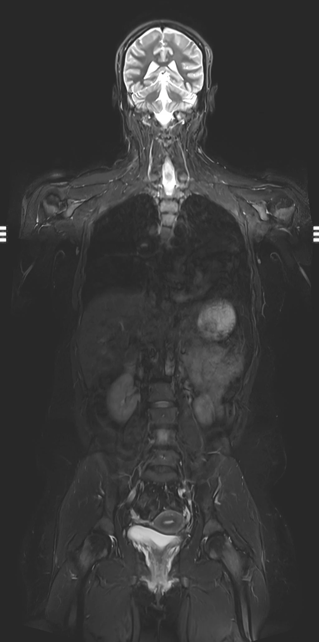 Whole-body coronal STIR MRI, SwiftMR scan
