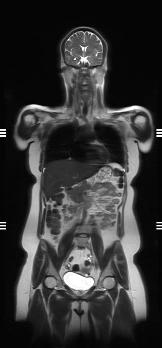 Whole-body coronal T2 MRI, conventional scan