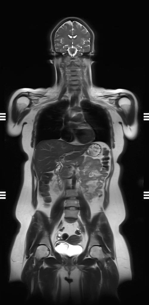 Whole-body coronal T2 MRI, SwiftMR scan
