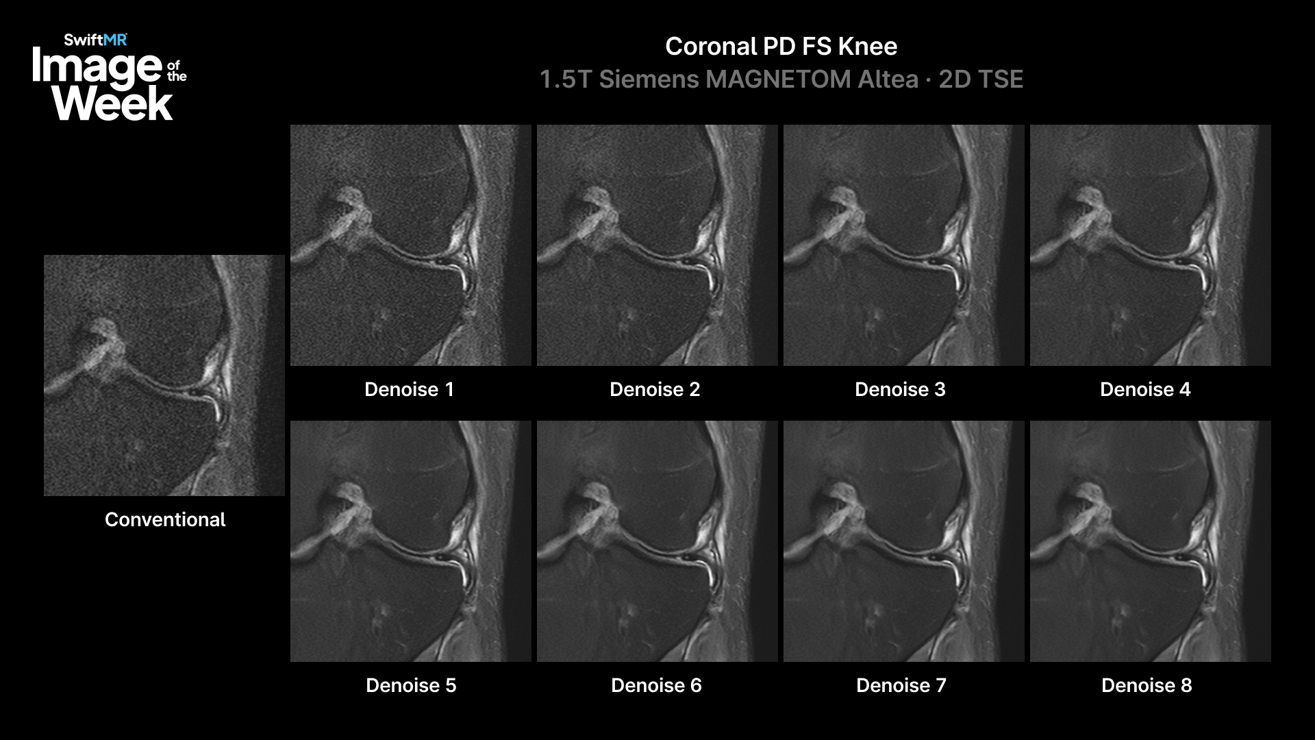 Showing 8 different levels of denoising on an knee MRI image with SwiftMR AI image reconstruction solution