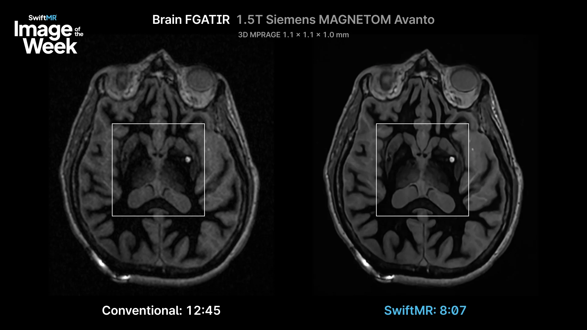 Comparison of Brain FGATIR on SwiftMR AI MRI image enhancement