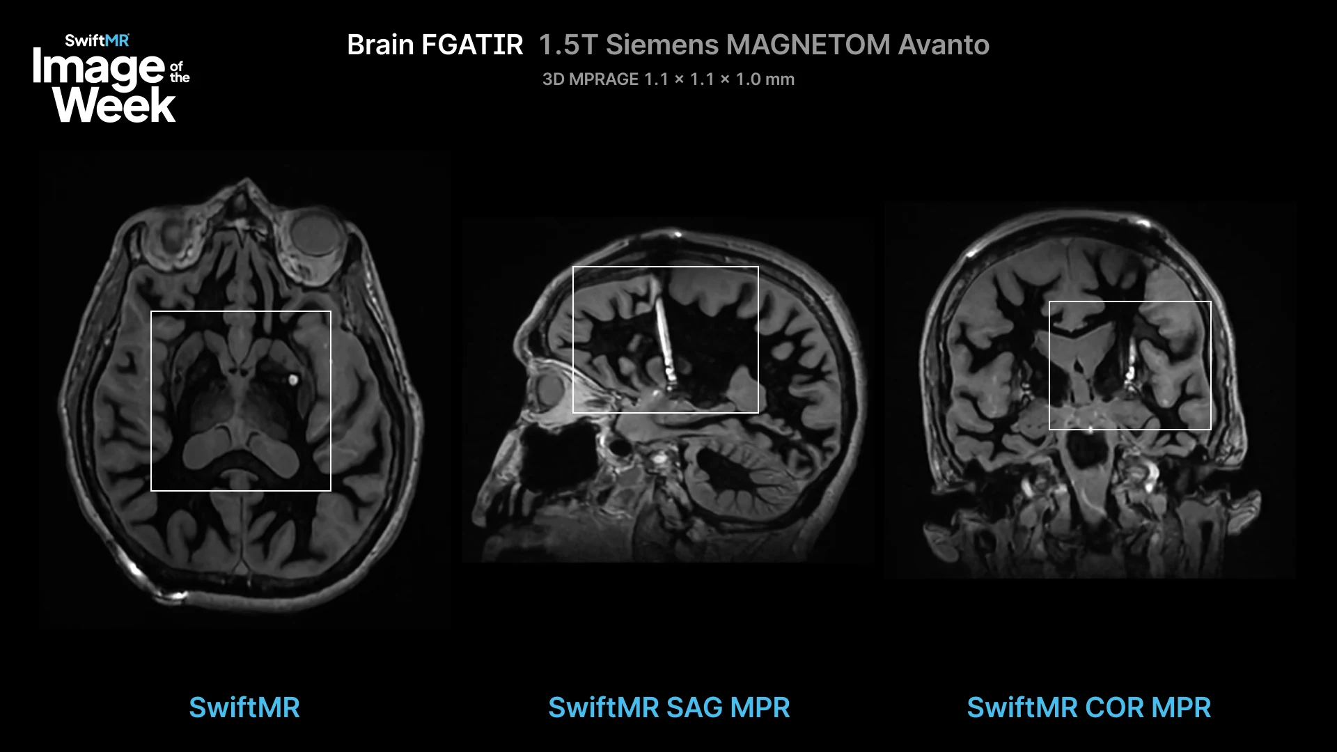 Various slices of Brain FGATIR on SwiftMR AI MRI image enhancement