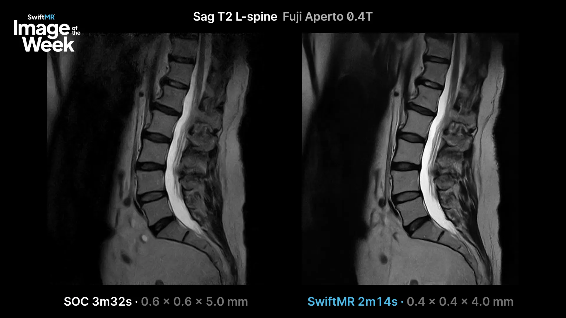 Standard-of-care and SwiftMR Sagittal T2 lumbar spine imaging acquired on a Fujifilm APERTO 0.4T.