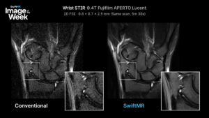 Comparison: conventional wrist STIR, and the same STIR data processed with SwiftMR reconstruction.