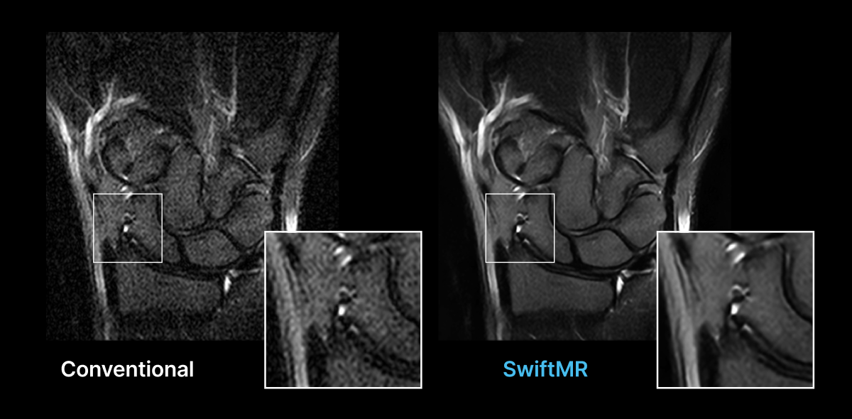 Wrist STIR MRI before and after SwiftMR reconstruction at 0.4T.
