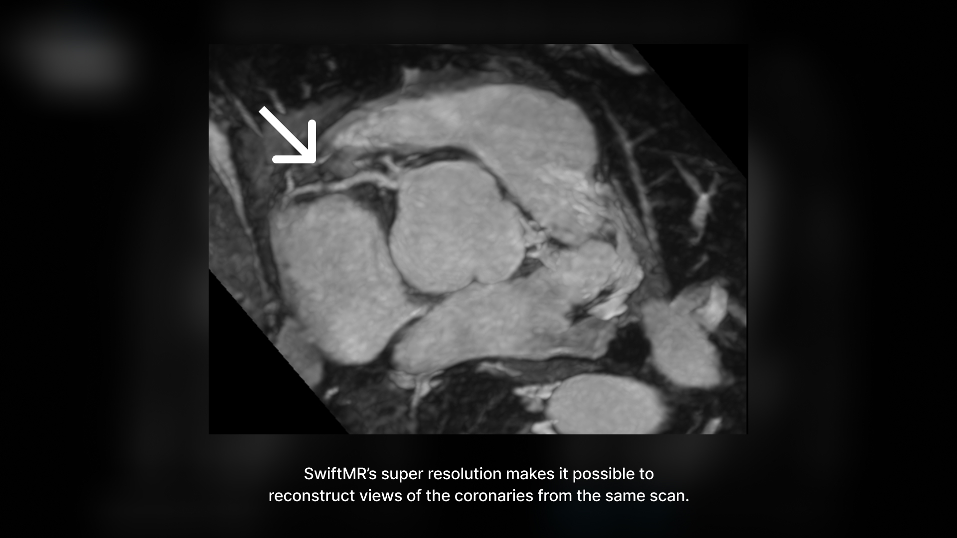 Image of coronary from reconstructed MRI image