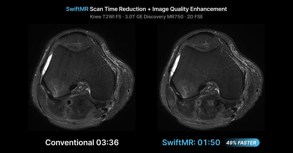 Comparison of Knee T2WI image on Conventional vs SwiftMR MRI