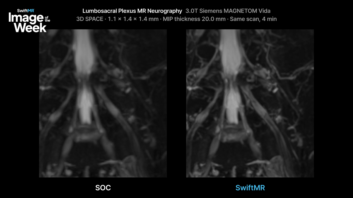 Image of Lumbosacral Plexus MR Neurography, scanned on a 3.0T Siemens MAGNETOM Vida
