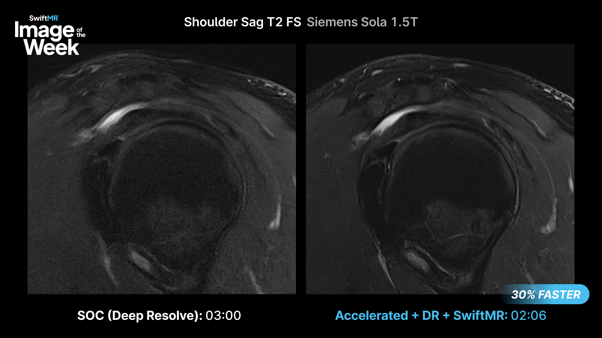Sagittal T2 FS shoulder MRI on a Siemens Sola 1.5T: standard of care with Deep Resolve Boost at 3:00 compared with Deep Resolve Boost plus SwiftMR at 2:06.