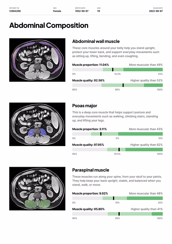 Report page: abdominal muscle, with abdominal wall, psoas major and paraspinal muscle segmented on MRI