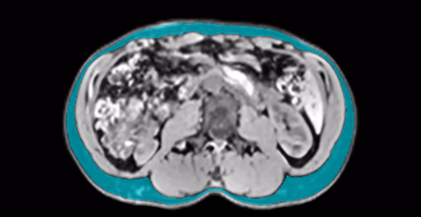 Abdominal SAT MRI slice, Patient A
