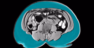 Abdominal SAT MRI slice, Patient B