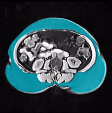 Subcutaneous adipose tissue, segmented in teal on an abdominal MRI slice