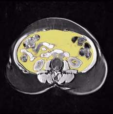 Visceral adipose tissue, segmented in yellow on an abdominal MRI slice