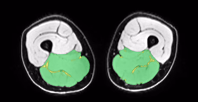Hamstrings & adductors MRI slice, Patient A