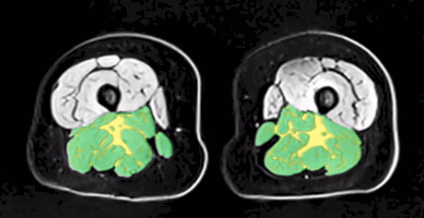 Hamstrings & adductors MRI slice, Patient B