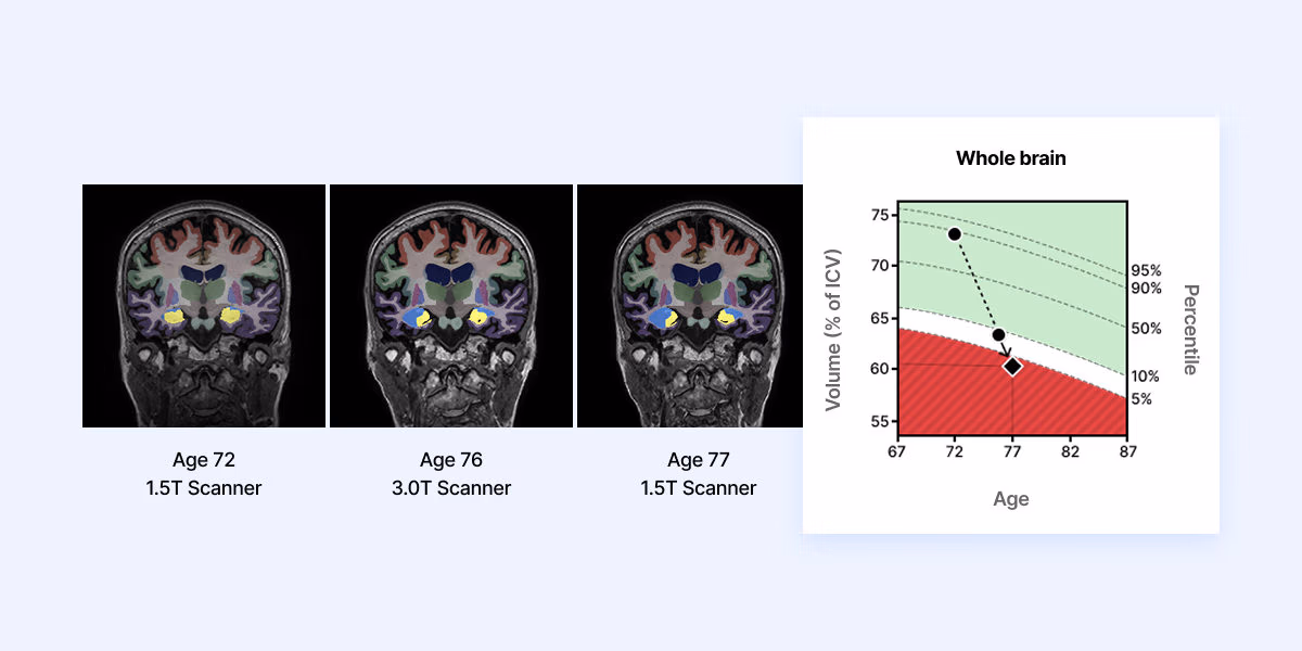 Three follow-up scans of one patient at ages 72, 76, and 77 across 1.5T and 3.0T scanners, with whole-brain volume tracked against normative percentiles