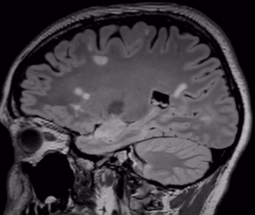 Sagittal FLAIR, baseline exam at age 31