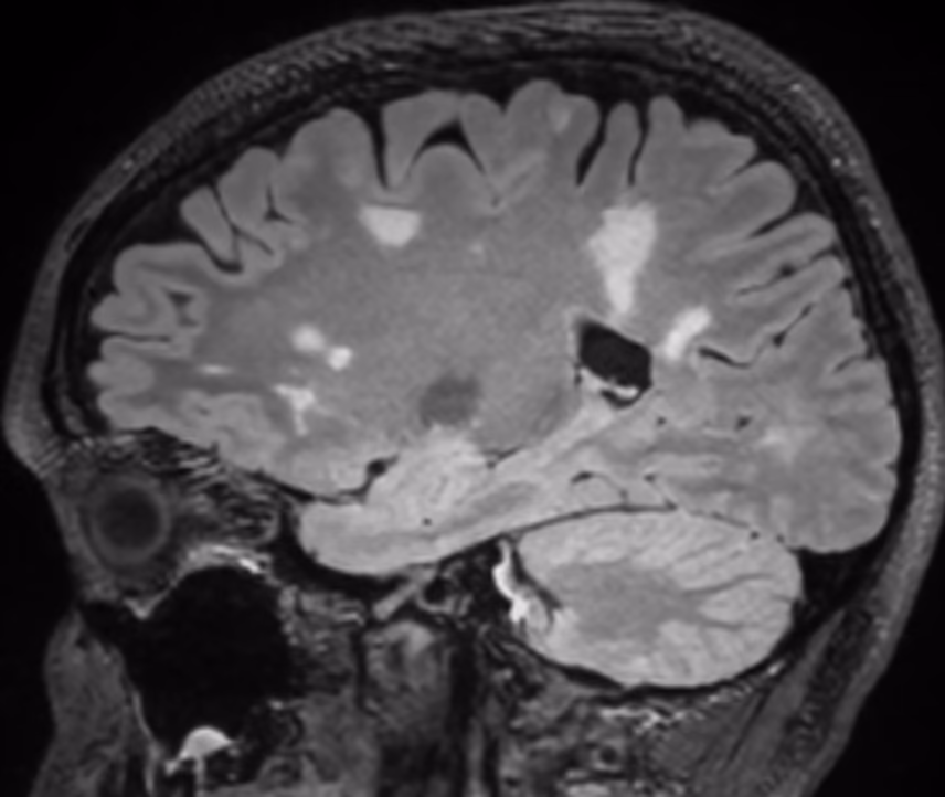 Sagittal FLAIR, follow-up exam at age 39