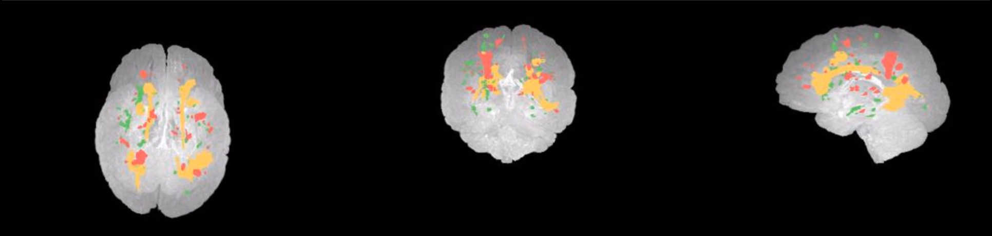 SwiftSight report glass brain views showing lesion locations