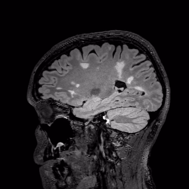 Sagittal FLAIR, follow-up exam at age 39
