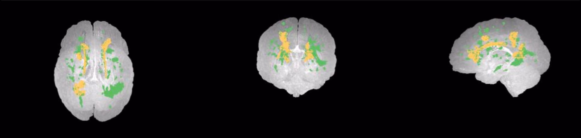 SwiftSight report glass brain views showing lesion locations