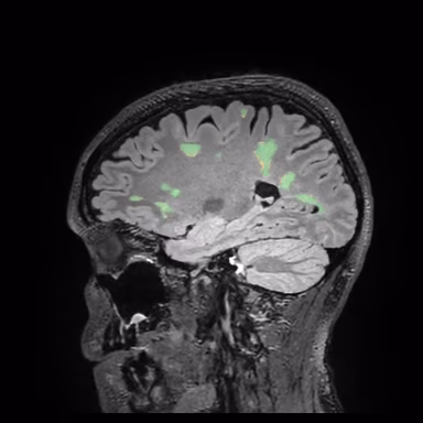 SwiftSight lesion overlay with the parietal lesion classified as enlarging