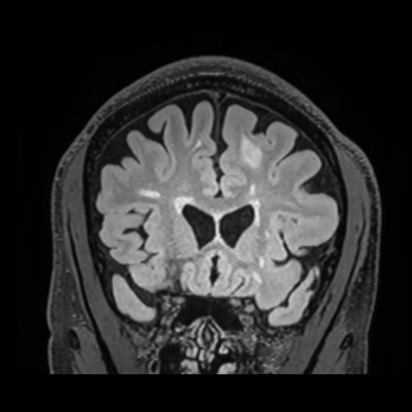 Coronal MRI, follow-up on Siemens 3T, female patient, age 42–43