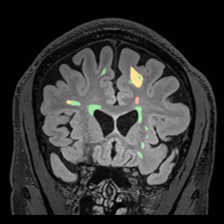 Coronal MRI, SwiftSight lesion map on the follow-up, female patient, age 42–43