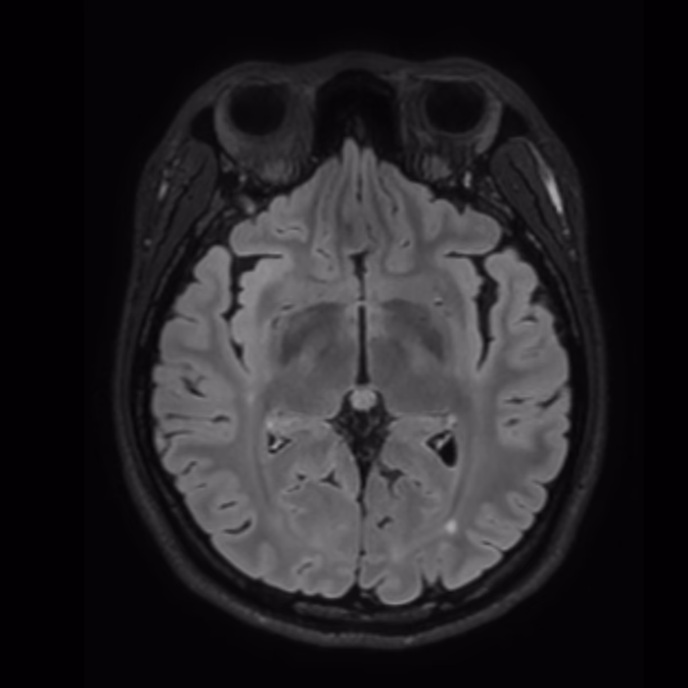 Axial MRI, baseline on Philips 3T, female patient, age 24–27