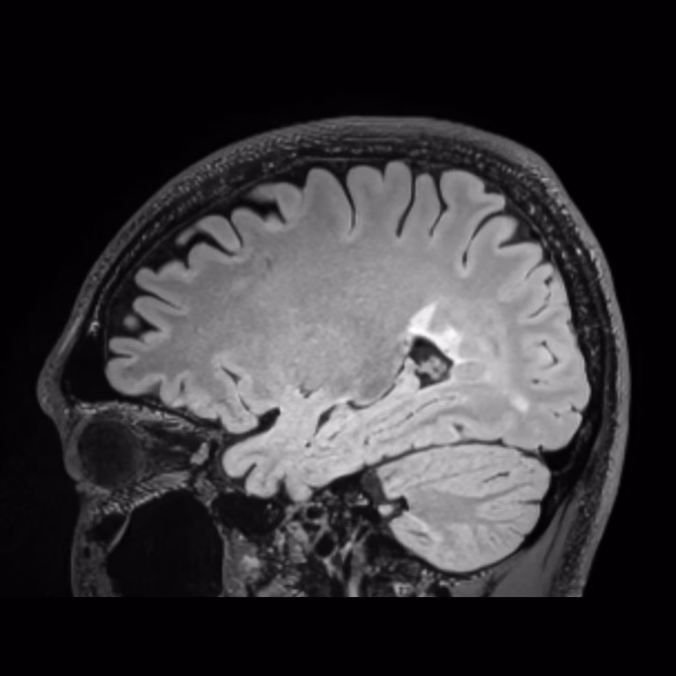 Sagittal MRI, follow-up on Siemens 3T, male patient, age 26–27