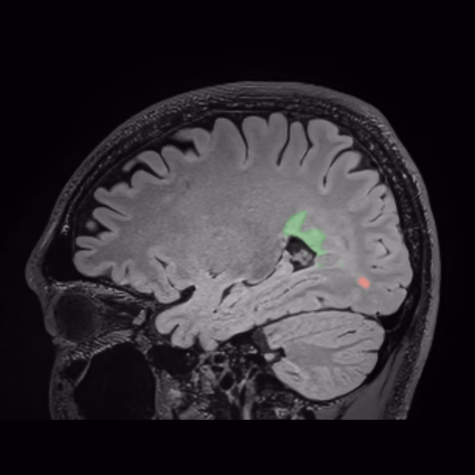 Sagittal MRI, SwiftSight lesion map on the follow-up, male patient, age 26–27