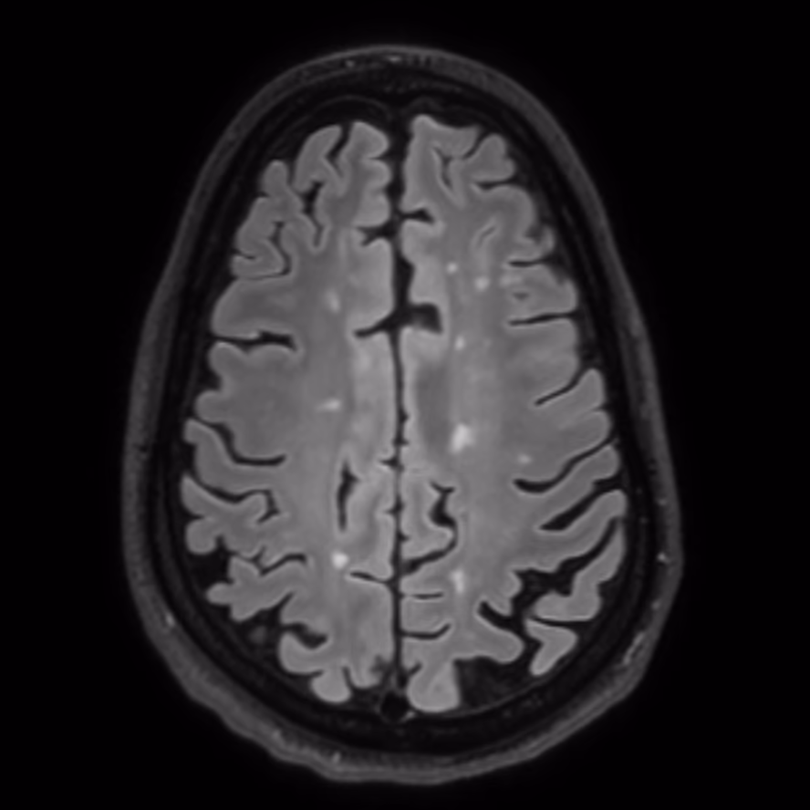 Axial MRI, baseline on Philips 3T, male patient, age 47–48