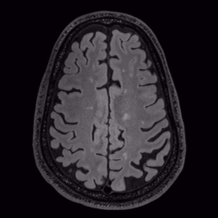 Axial MRI, follow-up on Siemens 3T, male patient, age 47–48