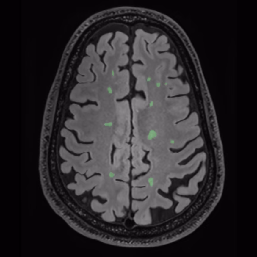 Axial MRI, SwiftSight lesion map on the follow-up, male patient, age 47–48