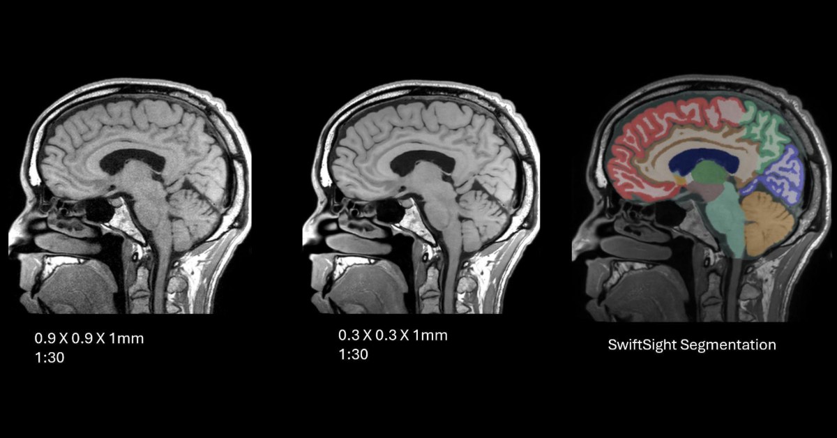Sagittal 3D T1 brain MRI acquired in 1:33 shown as acquired, after SwiftMR reconstruction, and with SwiftSight volumetry segmentation