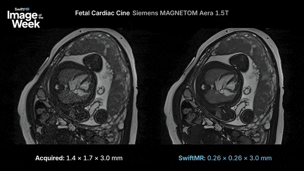 Fetal cardiac cine MRI on a Siemens MAGNETOM Aera 1.5T, conventional reconstruction on the left and SwiftMR reconstruction on the right.