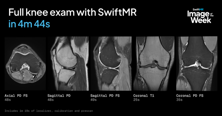 Full knee MRI exam in 4m 44s with SwiftMR on United Imaging scanner